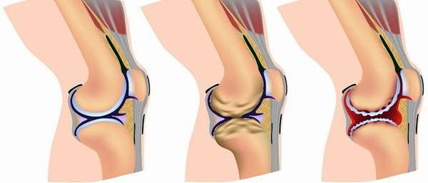 Деформирующий артроз сустава колена